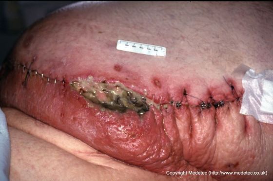 Dehisced Surgical Wound, Bariatric Patient