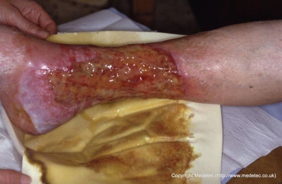 Removal of wound dressing ineffective in managing exudate