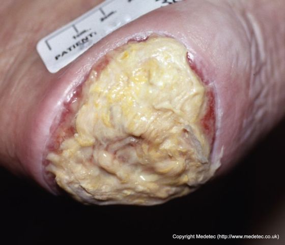 Sloughy Heel Pressure Ulcer, Unstageable