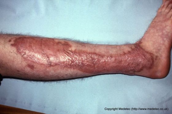 Skin graft site, lower leg