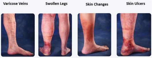 Venous Insufficiency is treated at Encompass HealthCare and Wound Medicine, West Bloomfield, Michigan