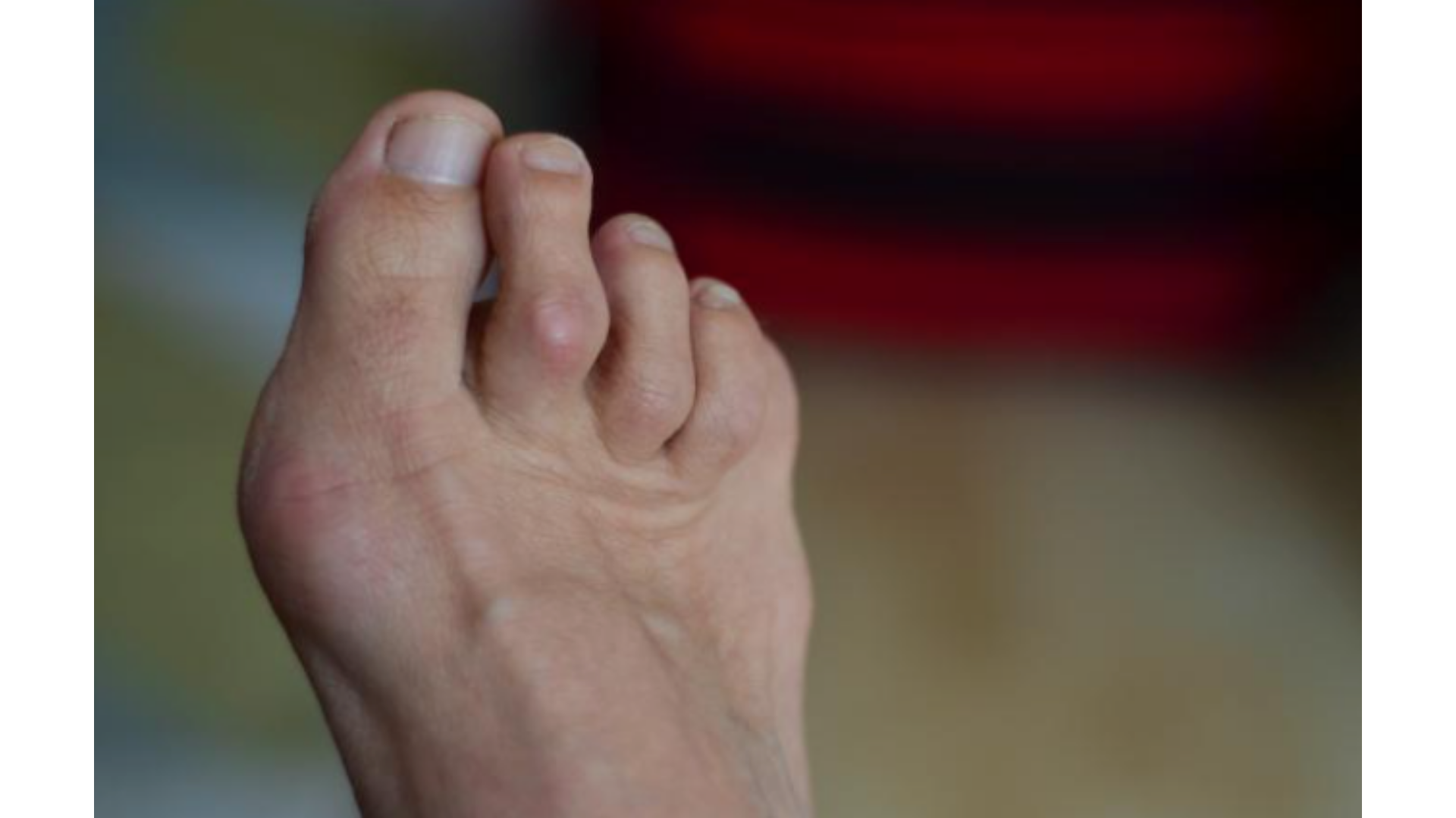 superior to inferior view of a forefoot including toes