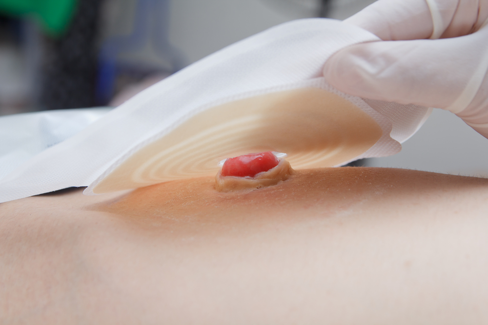 Closeup stoma and colostomy after colon cancer surgery