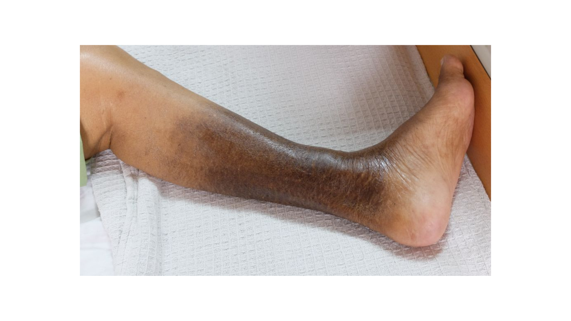Venous Leg Ulcers and Comorbidities
