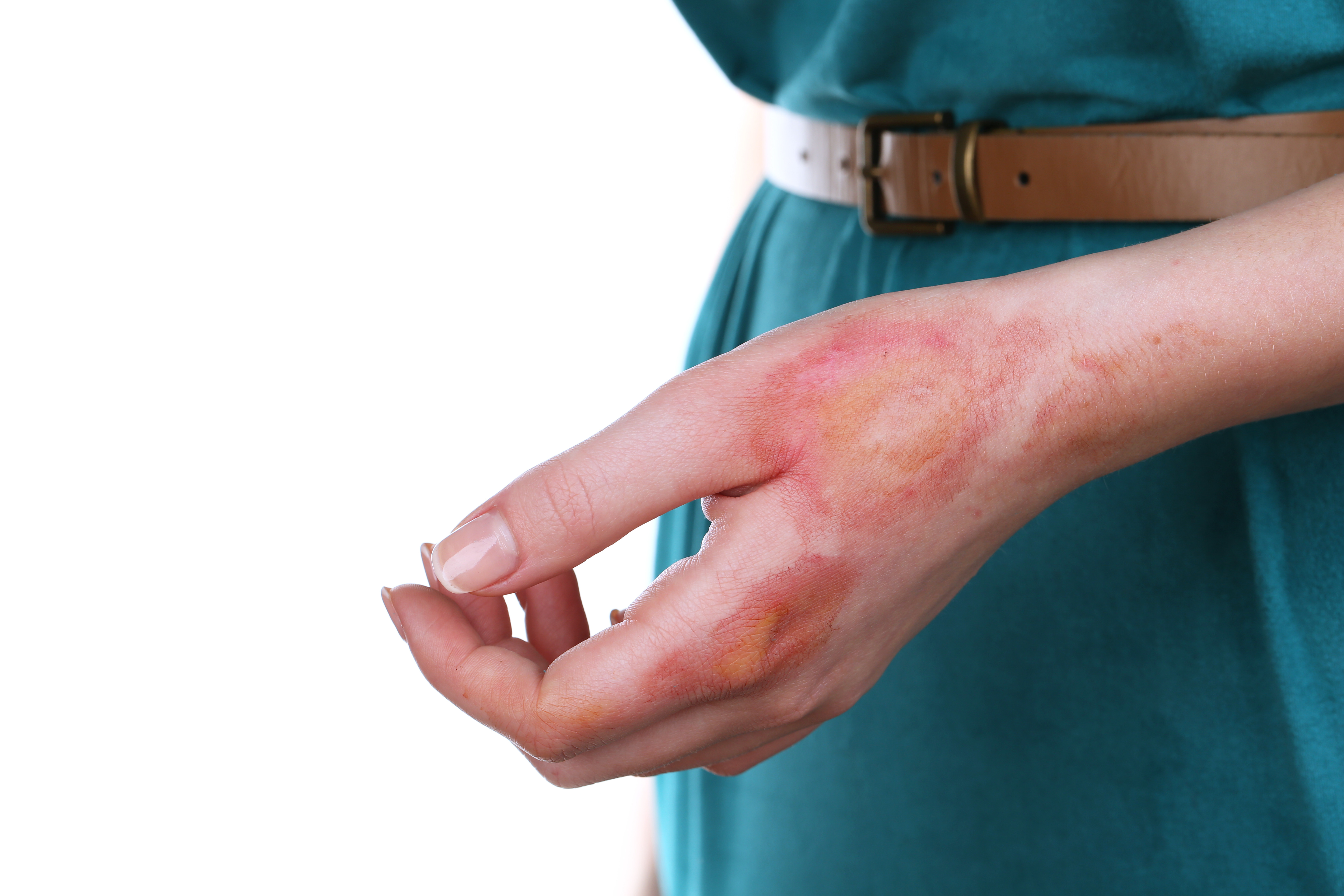 Burn Wound Management and Treatment