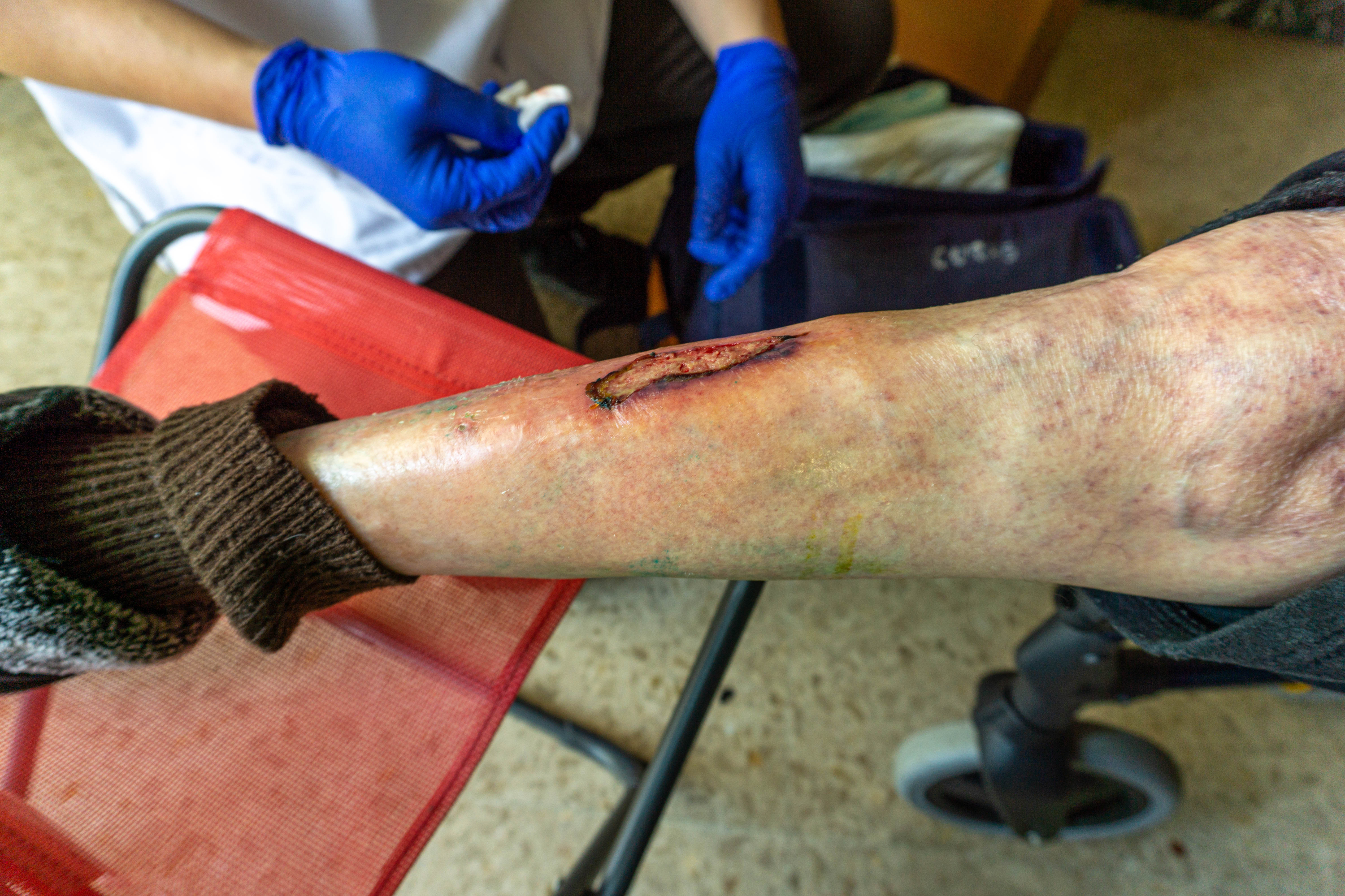 Lower Extremity Wound 