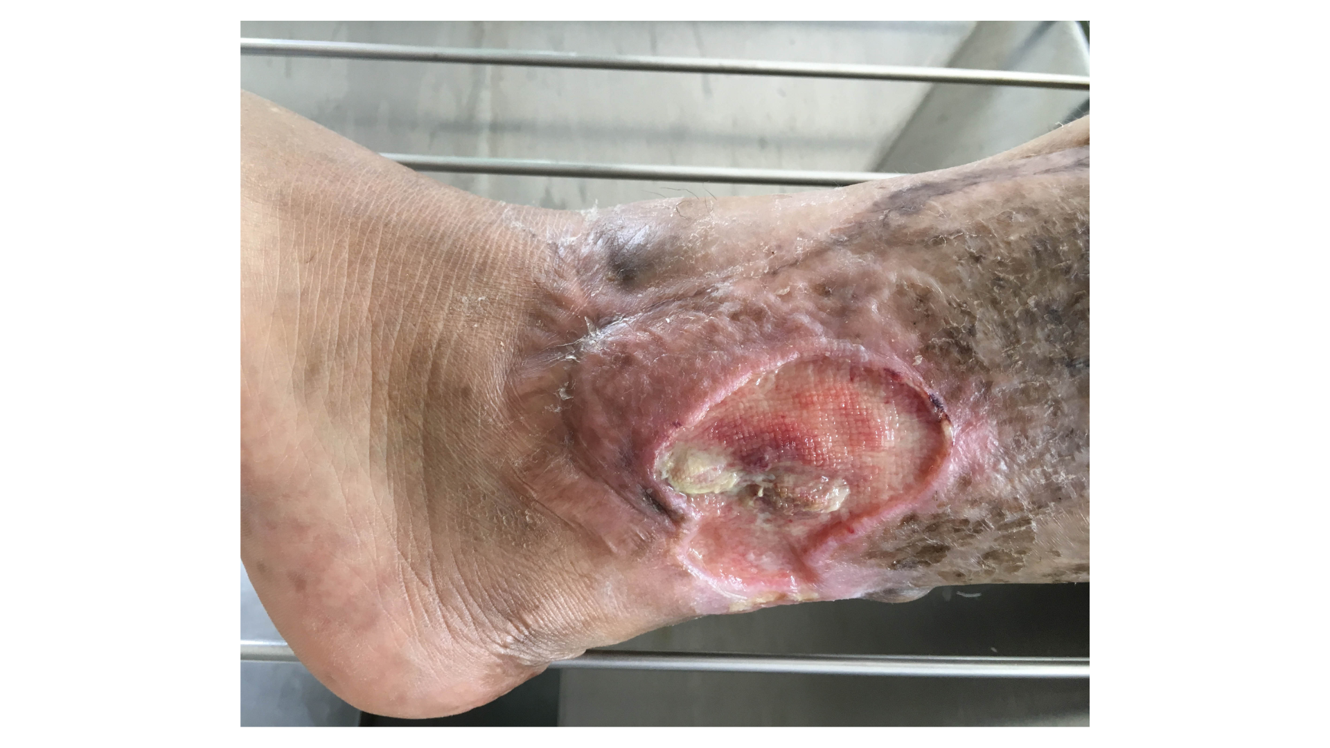 Test Your Knowledge on Chronic Wounds