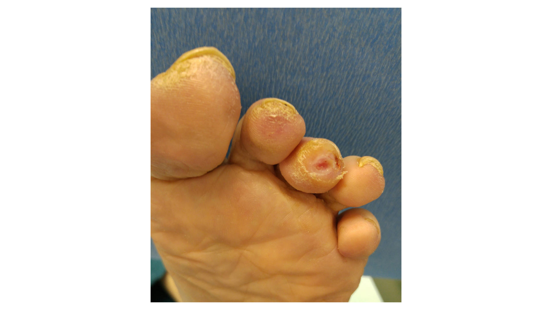 Diabetic foot ulcer on a patient's toe