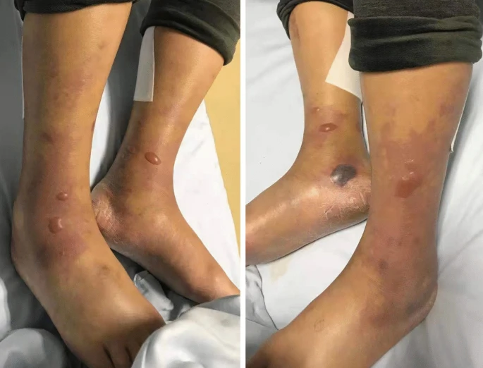 V. vulnificus lesions