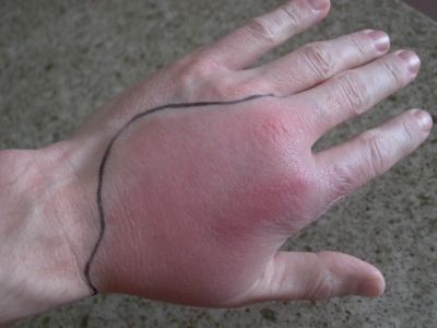 cellulitis_hand.jpg