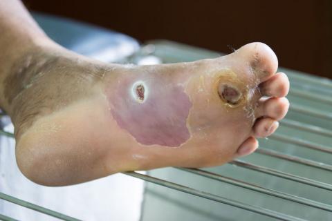 Diabetic Foot Ulcer