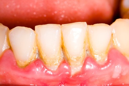 dental_biofilm.jpg