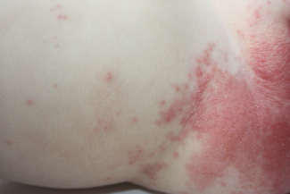 Severe diaper discount rash treatment