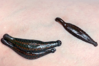Leech Therapy for Flap Salvage