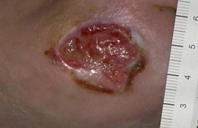 Maggot Therapy Use in Wound Care