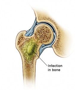 osteomyelitis-bone-pic-252x300.jpg