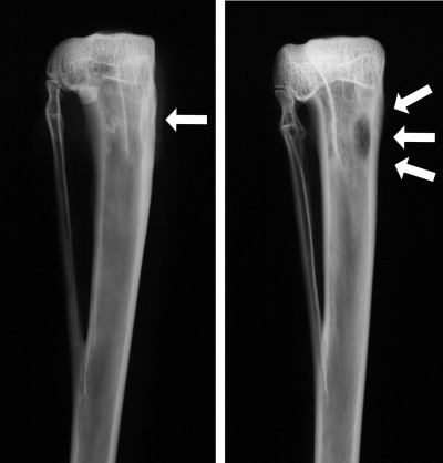 Osteomyelitis