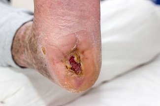 Diabetic Foot Ulcers