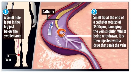 clarivein.jpg