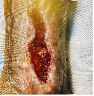 clinical_photograph_from_may_2021_of_right_leg_venous_ulceration_consent_obtained.jpg