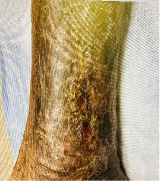 clinical_photograph_of_healed_right_leg_consent_obtained.jpg