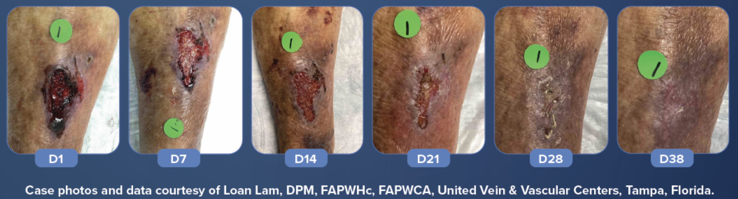 Leg ulcer healing over time