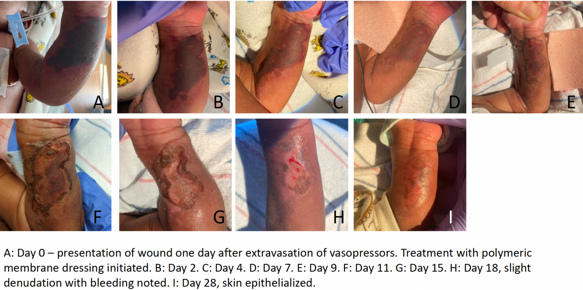 acute_treatment_of_extravasation_injuries_polymeric_membrane_dressings_case_study_image.png