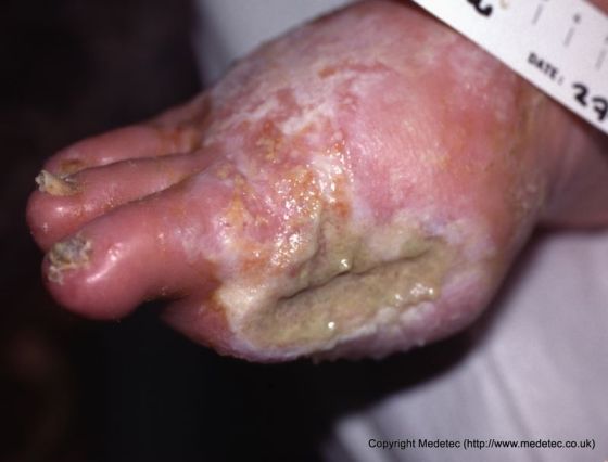 Infected Wounds, Causes, Symptoms and Treatment | WoundSource