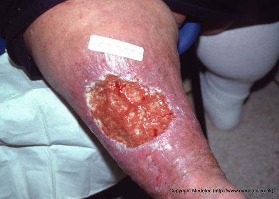 Bariatric Leg Ulcer