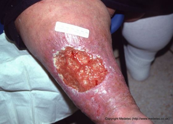 Leg Ulcer, Bariatric Patient Bariatric Leg Ulcer