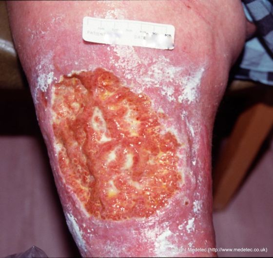 Venous Insufficiency Ulcer, Bariatric