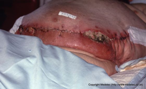 Dehisced surgical wound