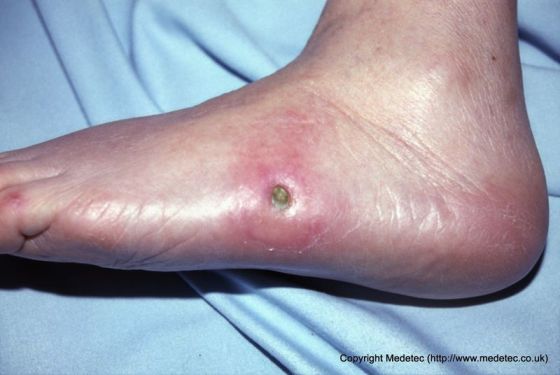 Effective Diabetic Foot Ulcer Treatment in Los Angeles | LA Vascular  Specialists