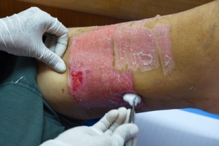 Skin graft donor site