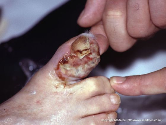 Infected Toe Wound and Nail Bed