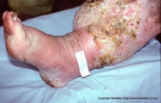 edema of the leg