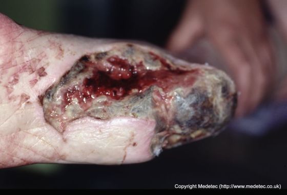 Necrotic Diabetic Foot