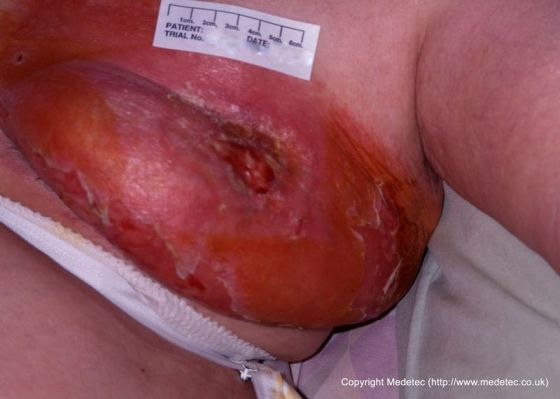 Radiation dermatitis, breast cancer treatment Radiation dermatitis, breast cancer treatment