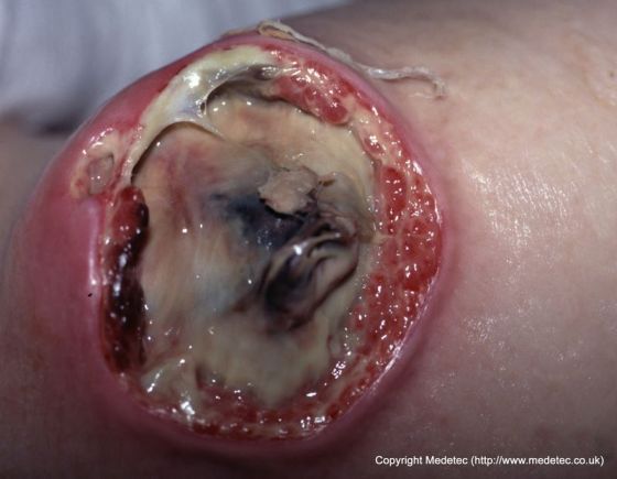 Slough Covered Pressure Ulcer, Unstageable