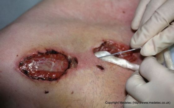Tunneling wound Tunneling wound