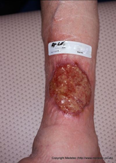 Venous Insufficiency Ulcer