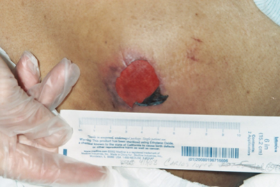 Moisture Associated Skin Damage What It Is and What It Isn t