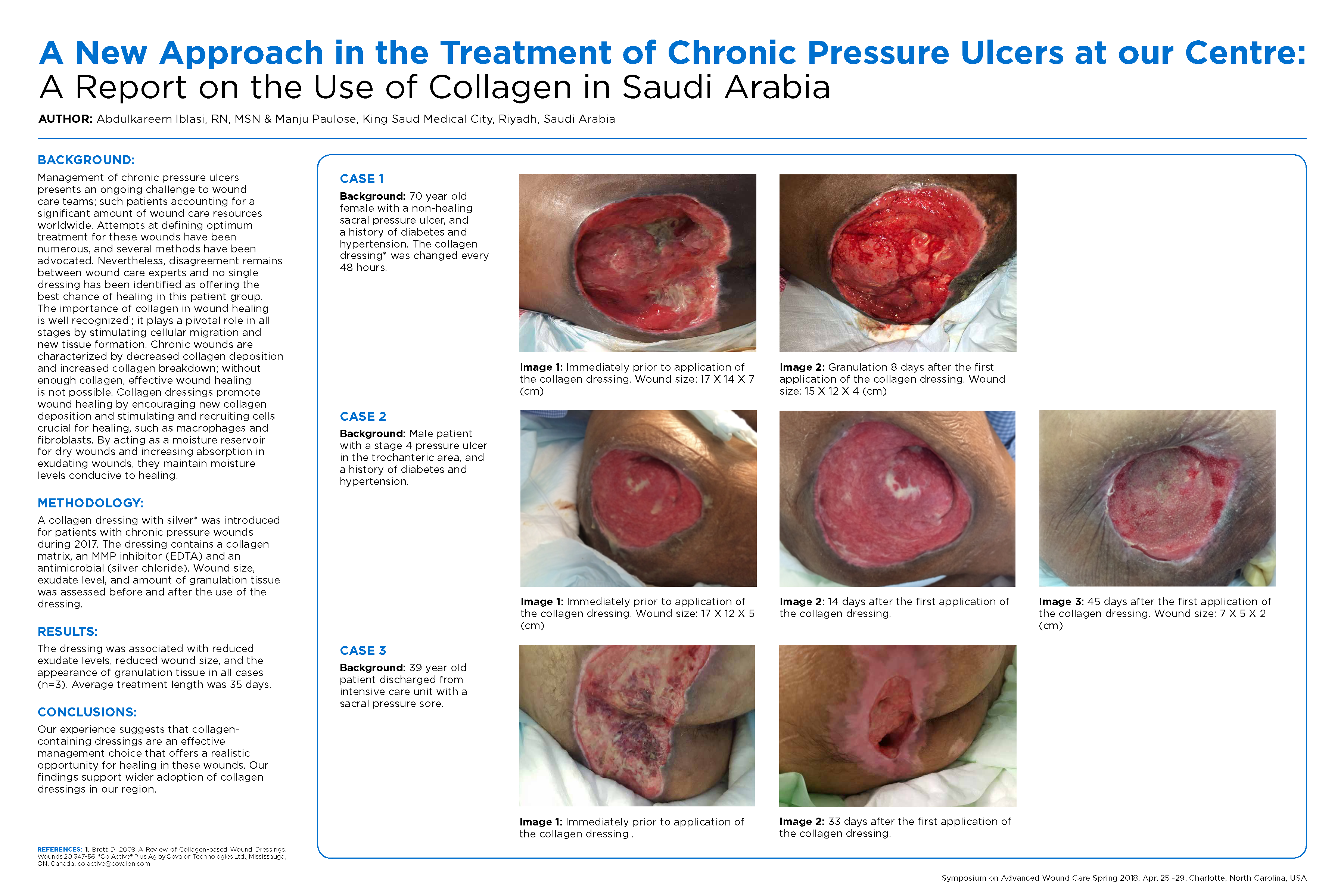 A New Approach In The Treatment Of Chronic Pressure Ulcers At Our Centre: A  Report On The Use Of Collagen In Saudi Arabia | Woundsource