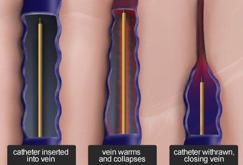 radiofrequency_ablation.jpg