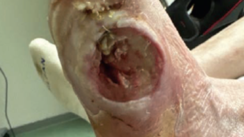 Pressure Injury–Associated Osteomyelitis: Why Diagnostic Accuracy Matters