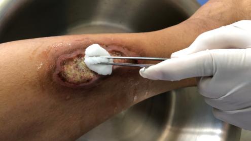 infected DFU