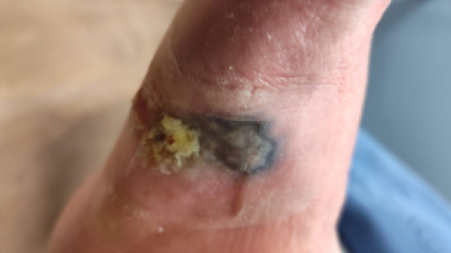 NPWT Courtesy of Podiatry Today