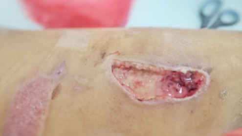 Pressure Injury Prevention: Why It Remains a Critical Patient Care Priority in Wound Care