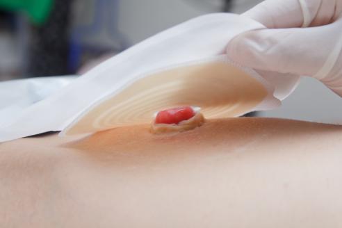 Closeup stoma and colostomy after colon cancer surgery