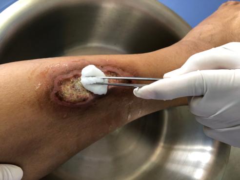 infected DFU